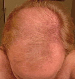 FOLIGAIN Low Alcohol Minoxidil 5% Hair Regrowth Treatment For Men 6 Month Supply - FOLIGAIN EUROPE